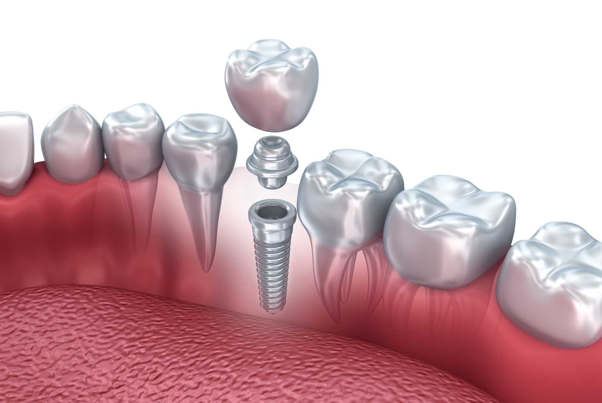 impianti denti